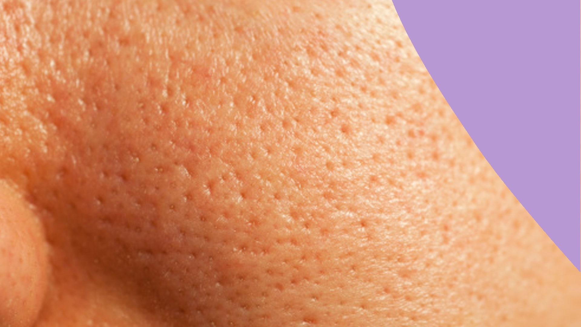 Clogged Pores Causes  How To Treat Them ASAP