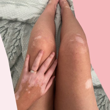 I've lived with vitiligo almost my whole life, here's why June 25th is the most important day for me
